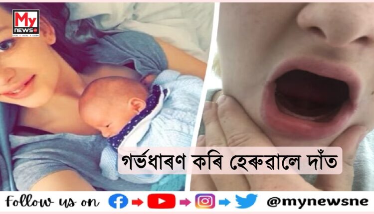 Woman lost teeth during pregnancy : গৰ্ভাৱস্থাত মহিলাই হেৰুৱালে সমস্ত দাঁত, কিন্তু কিয় ?