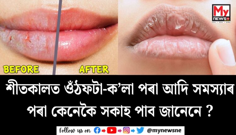 Do you know how to get rid of dark lips in winter:শীতকালত ওঁঠফটা-ক’লা পৰা আদি সমস্যাৰ পৰা কেনেকৈ সকাহ পাব জানেনে ?